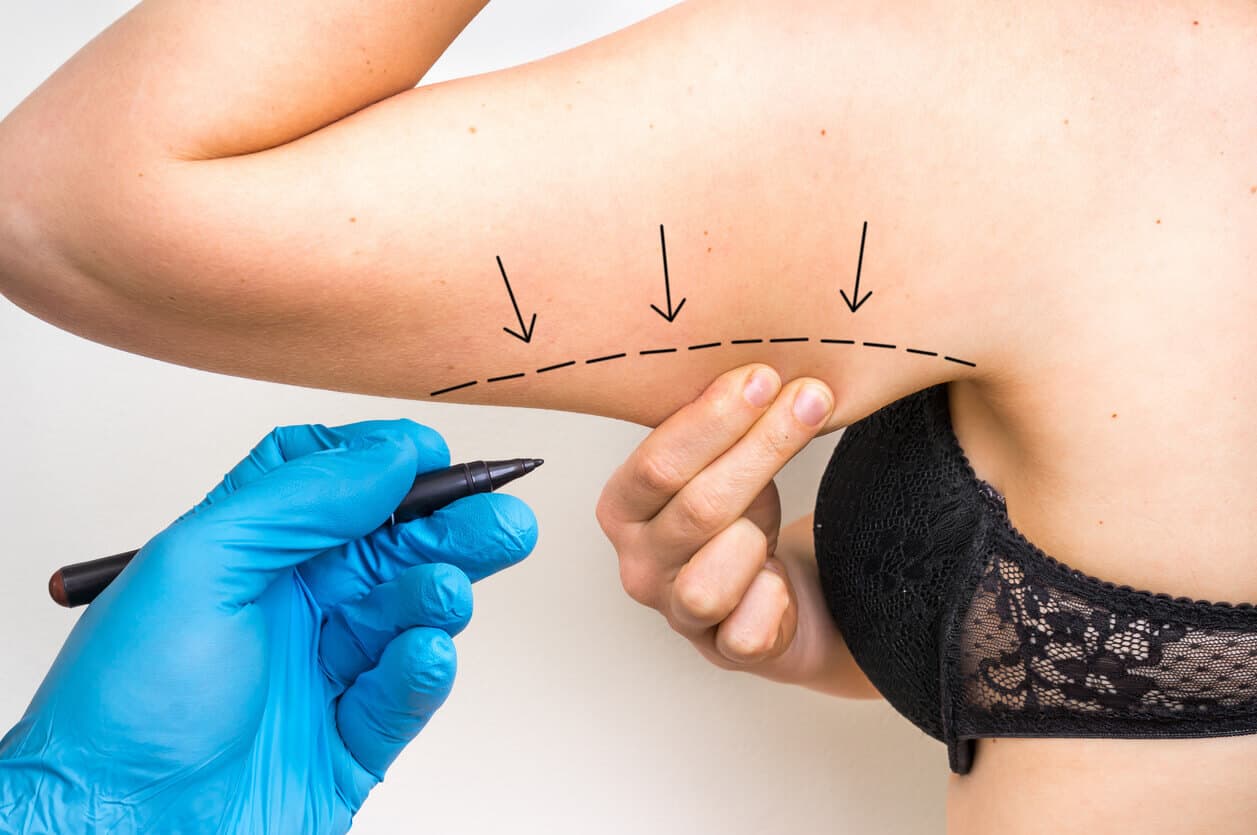 Mulher segurando o excesso de gordura localizada no braço enquanto cirurgião faz marcações
